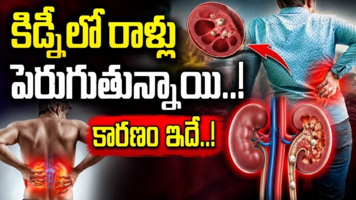 Kidney Stones Cases Alarmingly on rise In India